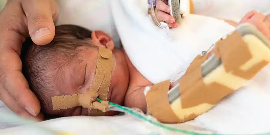 A premature baby in the NICU